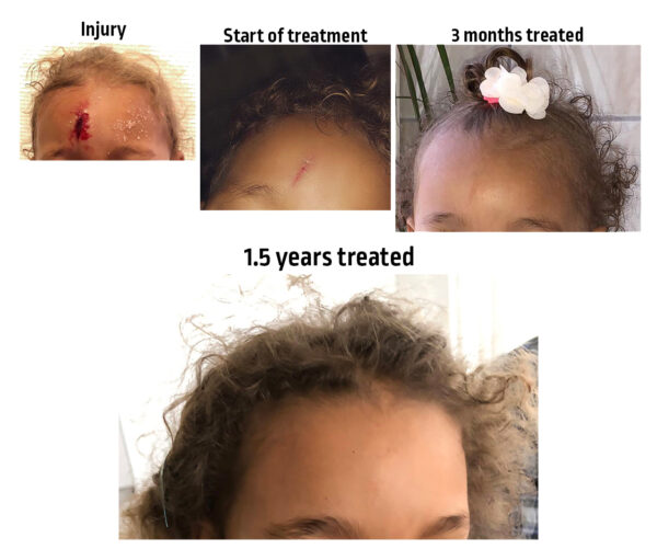 Product Improscar Stick After Benefits Image